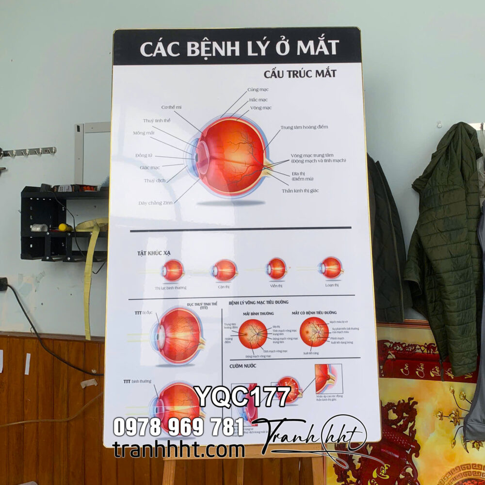 Tranh Y khoa Các Bệnh Lý Ở Mắt, tranh Cấu Trúc Và Tật Khúc Xạ tráng gương treo tường, Tranh Nhãn khoa treo tường YQC177