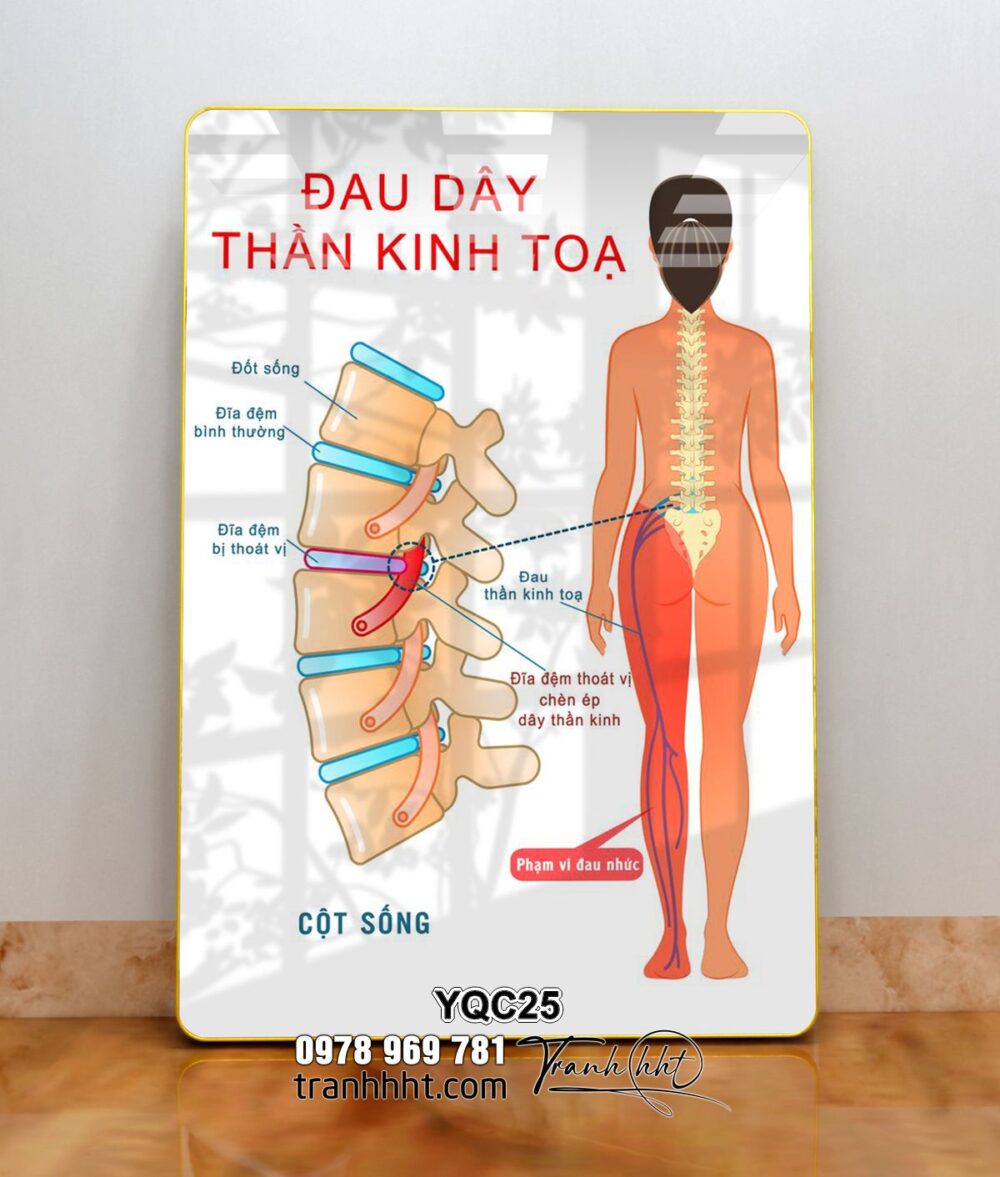 Tranh y khoa treo tường, Tranh phòng khám Y khoa đau dây thành kinh tọa tráng gương treo tường YQC25