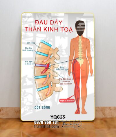 Tranh y khoa treo tường, Tranh phòng khám Y khoa đau dây thành kinh tọa tráng gương treo tường YQC25