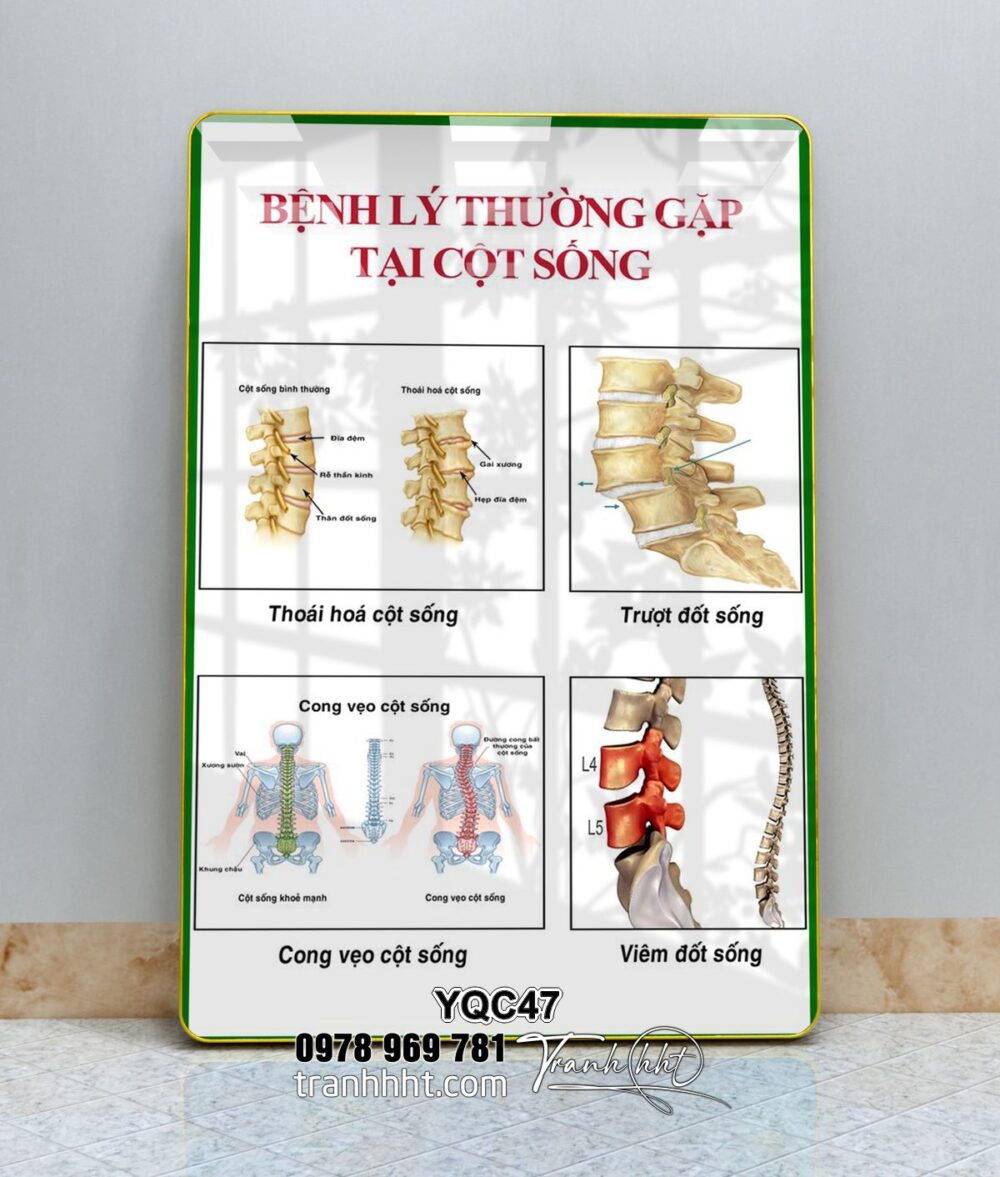 Tranh phòng khám y khoa, tranh y tế, tranh cơ xương khớp, Tranh Y khoa bệnh lý hay gặp ở cột sống tráng gương treo tường YQC47