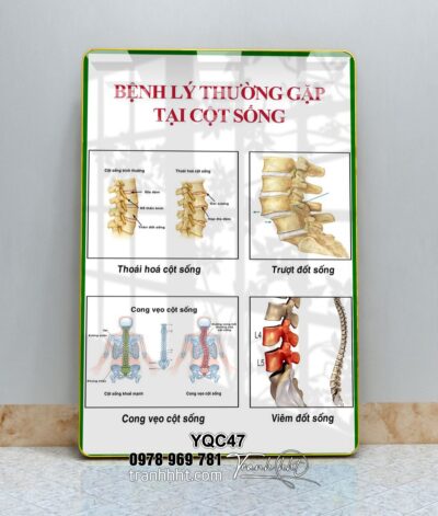 Tranh phòng khám y khoa, tranh y tế, tranh cơ xương khớp, Tranh Y khoa bệnh lý hay gặp ở cột sống tráng gương treo tường YQC47