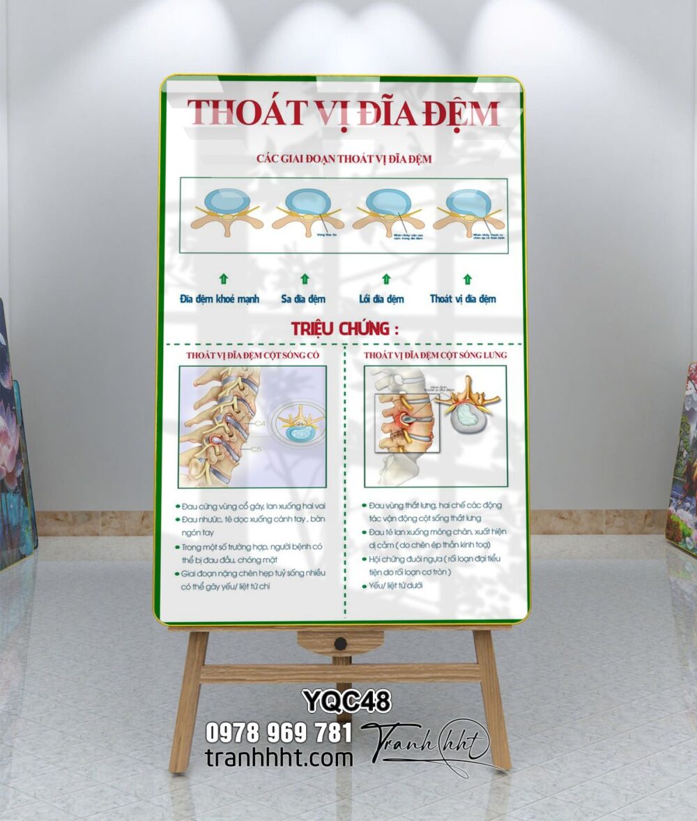 Tranh phòng khám y khoa, tranh xương khớp, tranh đốt sống cổ, Tranh Y khoa triệu chứng bệnh thoát vị đĩa đệm tráng gương treo tường YQC48