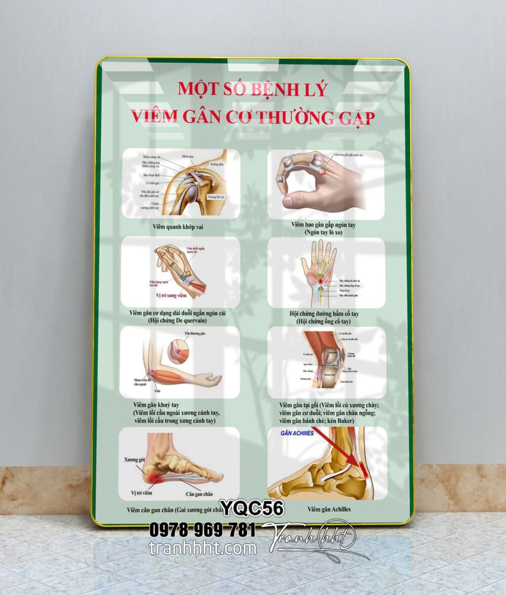 Tranh viêm gân, tranh hệ xương khớp, Tranh Y khoa bệnh lý viêm gân cơ thường gặp tráng gương treo tường YQC56
