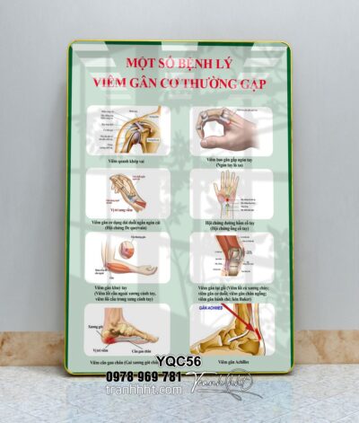 Tranh viêm gân, tranh hệ xương khớp, Tranh Y khoa bệnh lý viêm gân cơ thường gặp tráng gương treo tường YQC56