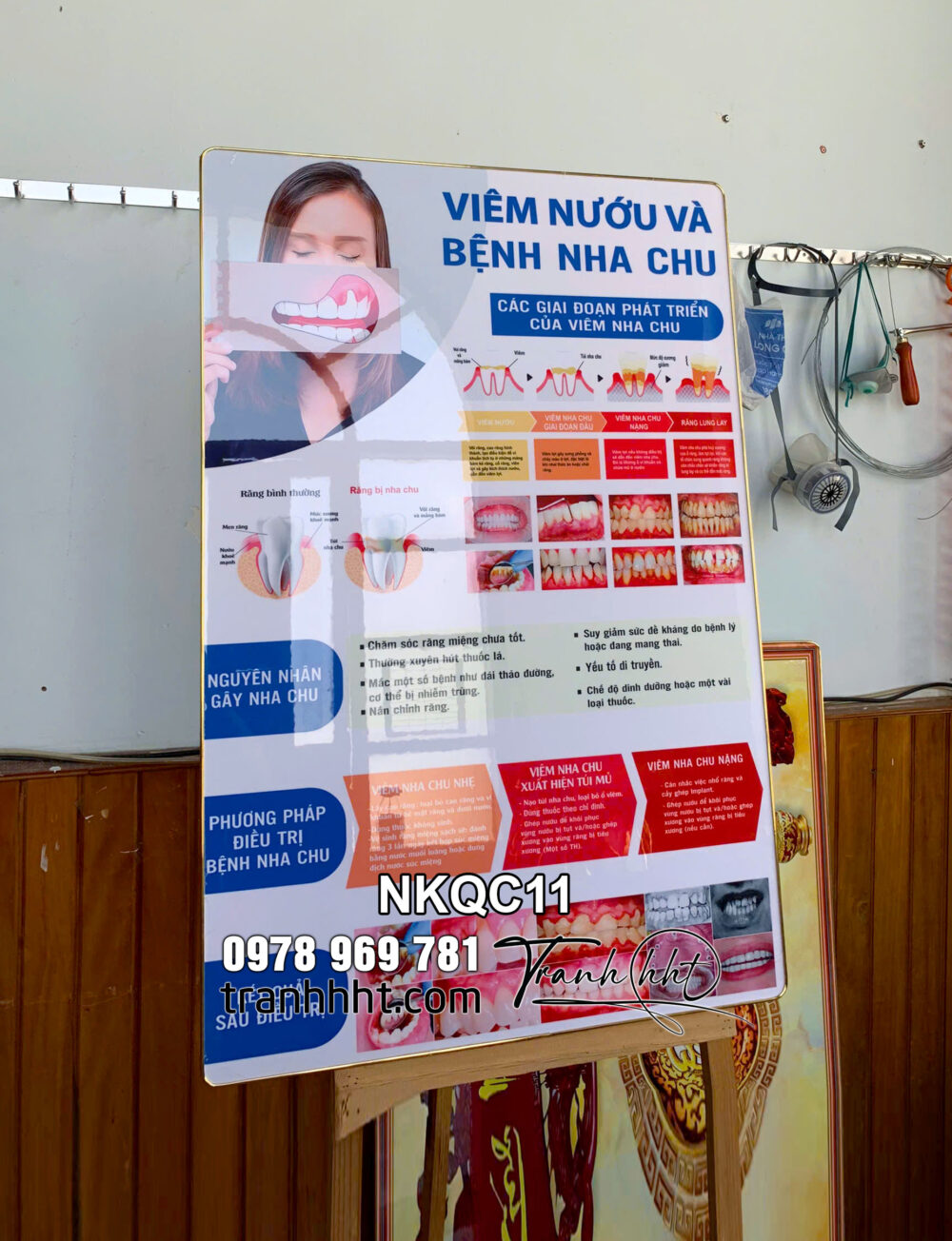 Tranh phòng khám nha khoa, tranh bệnh lý răng miệng, Tranh Nha Khoa viêm nướu và bệnh nha chu tráng gương NKQC11