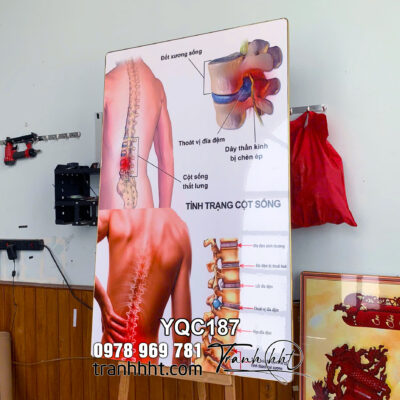 Tranh Y khoa Y Tế tình trạng cột sống thắt lưng và các bệnh lý thoát vị đĩa đệm tráng gương treo tường YQC187