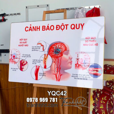 Tranh Y Tế treo tường, Tranh tài liệu y tế y khoa treo tường, Sách y tế, Tranh Y khoa cảnh báo đột quỵ tráng gương YQC42